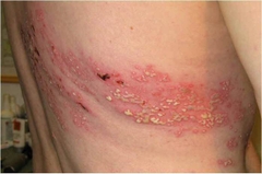 lupus-ban-do-he-thong-va-benh-zona-than-kinh