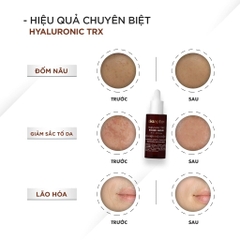 Serum trắng da mờ thâm sạm Ekseption TRX Tranexamic Acid & HA
