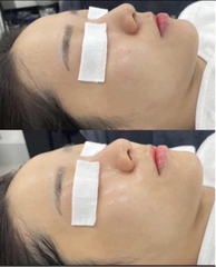 Mặt nạ phục hồi căng bóng da sau peel phi kim laser Civasan Hy Balsam Powder