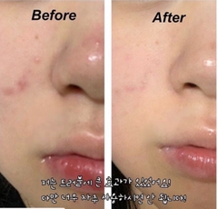 Tẩy da chết body BHA 2% Stridex XL Face and Body trị mụn lưng, ngực, viêm nang lông