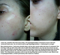 Toner giảm mụn Dickinson's Witch Hazel
