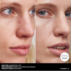 Trị thâm mụn, kiềm dầu Niacinamide The Inkey List 30ml