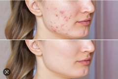Mặt nạ đất sét Aztec Secret Healing Clay