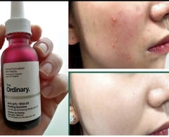 Serum tẩy da chết, tái tạo da The Ordinary AHA 30% + BHA 2% Peeling Solution