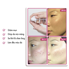 Toner Neogen Dermalogy Treatment Acid 5% AHA - BHA - PHA - LHA, Toner Tẩy Tế Bào Chết, Toner Giảm Mụn 150ml