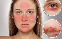 Cách thử mỹ phẩm có chứa corticoid đơn giản, chính xác nhất