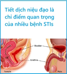 Cách tiếp cận phát hiện một số bệnh lây truyền qua đường tình dục