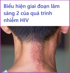 Giai đoạn lâm sàng 2 của HIV có biểu hiện gì?