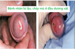 Chẩn đoán và điều trị bệnh lậu như thế nào?