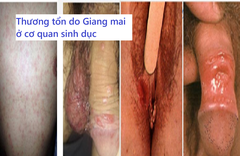 Chẩn đoán và điều trị bệnh Giang mai như thế nào?