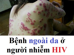 Bệnh ngoài da ở người nhiễm HIV trông như thế nào?