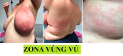 CẦN BIẾT NHỮNG ĐIỀU NÀY VỀ ZONA
