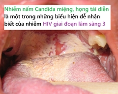 Nhiễm HIV giai đoạn lâm sàng 3 thì có dấu hiệu nào?