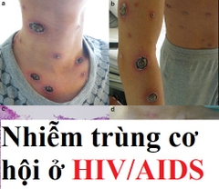 Nhiễm trùng cơ hội ở người mắc HIV