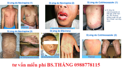 Tác dụng phụ của thuốc ARV đáng sợ như thế nào?