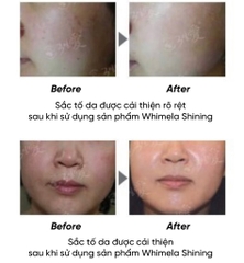 Kem cấy trắng da PP MESO bôi thoa kem dưỡng chứa kim vi sinh Bio Micro Needle tự nhiên tinh khiết dưỡng trắng nâng tông da làm mờ nếp nhăn và chống nhăn dưỡng trắng sâu bên trong da dành cho mọi loại da Three Days Love Whimela Shining Implant Cream 50ml