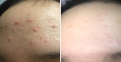 Xà Phòng Rửa Mặt Trị Mụn Và Làm Sạch Mụn Đầu Đen Soonnoc Aqua Cleansing Bar 100g