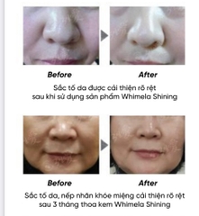 Kem cấy trắng da PP MESO bôi thoa kem dưỡng chứa kim vi sinh Bio Micro Needle tự nhiên tinh khiết dưỡng trắng nâng tông da làm mờ nếp nhăn và chống nhăn dưỡng trắng sâu bên trong da dành cho mọi loại da Three Days Love Whimela Shining Implant Cream 50ml