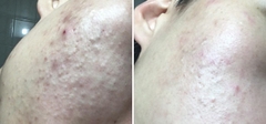 Xà Phòng Rửa Mặt Trị Mụn Và Làm Sạch Mụn Đầu Đen Soonnoc Aqua Cleansing Bar 100g