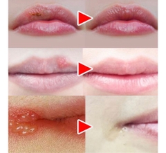 Son Dưỡng Môi Trị Khô Môi/ Chăm sóc tế bào chết môi/ trị mụn rộp môi Herpetino Lip Balm 10ml
