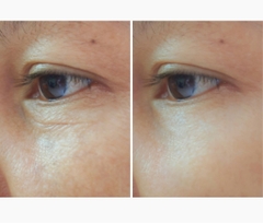 Kem dưỡng mắt EGF trị nếp nhăn quanh mắt và trị thâm da mắt