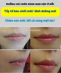 Son Dưỡng Môi Trị Khô Môi/ Chăm sóc tế bào chết môi/ trị mụn rộp môi Herpetino Lip Balm 10ml