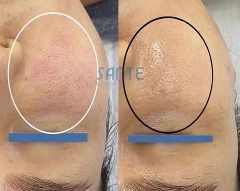 Serum peel da từ PHA và LHA dành cho da nhạy cảm SANTE Azulene Soother Peel Serum 50ml