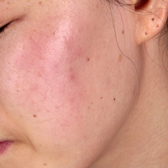 Mặt Nạ Ngủ Da Nhạy Cảm Mẩn Đỏ Merphil Red Skin Overnight Pack 100ml