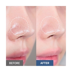 Tinh chất làm sạch mụn đầu đen bã nhờn không gây dị ứng B Project Bye Blackhead Melting Remover 30ml (Enzyme nhiệt giảm dị ứng)