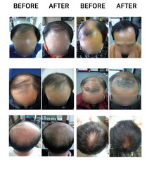 Tinh Chất cho da đầu chứa vi kim tự nhiên Phương pháp vi kim bôi thoa cho da đầu cấy dưỡng chất ngăn rụng và mọc tóc chăm sóc da đầu gàu điều tiết bã nhờn Three Days Love Phytobiome Scalp MTS Serum 