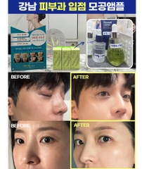 Tinh chất rong nho se khít lỗ chân lông và kiểm soát dầu bã nhờn MommyCare Sea Grapes Pore Lifting Ampoule 50ml (sản phẩm được bán tại phòng khám da liễu)