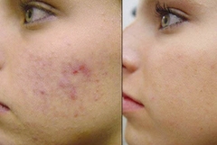 mua kem trị sẹo tại thành phố Hồ Chí Minh