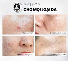 Tẩy Tế Bào Chết Home Peel Kiểm Soát Mụn, Giảm Viêm Và Giảm Tiết Dầu MD CARE AntiAc Exfo 30ml