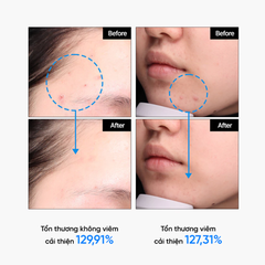 Tinh Chất Giảm Mụn Mờ Thâm Phục Hồi Da Mụn Feld Apotheke Phyto Calm Serum 30ml