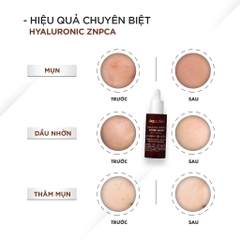 Serum Ekseption Hyaluronic ZnPCA, HA + 1% ZnPCA căng bóng, giảm mụn, kiềm dầu 75ml