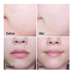 Serum SVR Tinh Chất Giảm Mụn Làm Mờ Thâm Sạm Và Mềm Mịn Da SVR Sebiaclear Serum 30ml