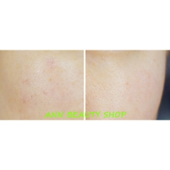 Kem dưỡng trắng trị nám BRTC PREMIUM VITALIZER WHITENING AMPOULE PACK