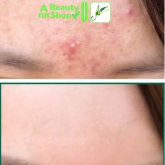 Bộ Dưỡng Trị Mụn Some By Mi Miracle AC SOS Kit [Set 4 Items]