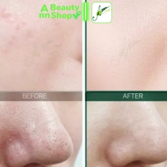 Bộ Dưỡng Trị Mụn Some By Mi Miracle AC SOS Kit [Set 4 Items]