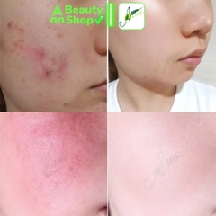 Kem Dưỡng Trị Mụn Some By Mi AHA-BHA-PHA 30 Days Miracle Cream