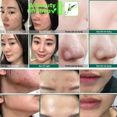 Set 3 item trị mụn Some By Mi AHA-BHA-PHA 30 Days Miracle Travel Kit