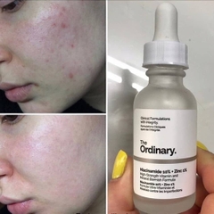 Tinh Chất The Ordinary Niacinamide 10% + Zinc 1% 30ml