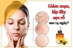 Tinh Chất Derladie Witch Hazel Perfect Vitamin Giảm Mụn, Hỗ Trợ Làm Mờ Sẹo (Mới) 35ml