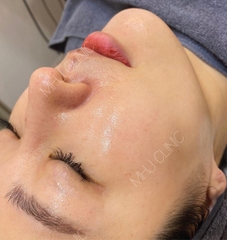 Microneedling - Cấy tinh chất Mulgwang căng bóng Hyal Balsam