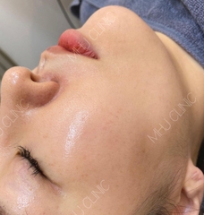 Microneedling - Cấy tinh chất Mulgwang căng bóng Hyal Balsam