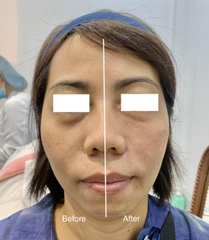 Tiêm tăng sinh Collagen PCL Gouri