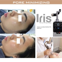 PORE MINIMIZING | Thu nhỏ lỗ chân lông & xử lý dầu nhờn kết hợp Laser Carbon & Meso thu nhỏ lỗ chân lông