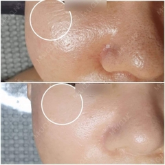 Sylfirm RF Microneedling - Kích Thích Collagen, Xóa Mờ Nếp Nhăn và Làm Thu Nhỏ Lỗ Chân Lông