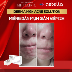 Miếng dán mụn Astella Derma Mg+ Acne Solution