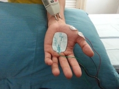 Các điện cực được dán trên da để đo dẫn truyền của dây thần kinh